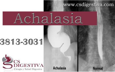 Diagnostico y Tratamiento de la Achalasia